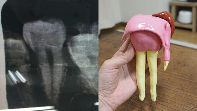歯のレントゲン写真がセクシーな脚に見えたので粘土で再現するというすごい記事